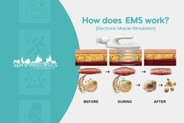 EMS treatment for post pregnancy weight loss treatment Halesowen