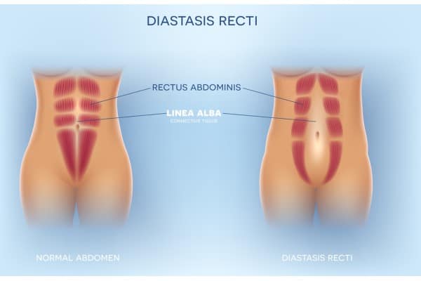 What Non-Surgical Options Are Available for Diastasis Recti Halesowen?