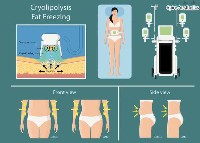 Image of diet and fat freezing combined for best results for Spire Aesthetics Halesowen
