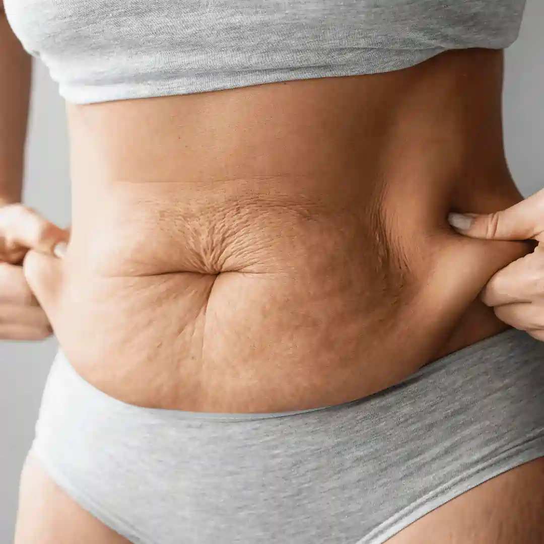 Is It Normal to Have Loose Skin After Pregnancy Halesowen?