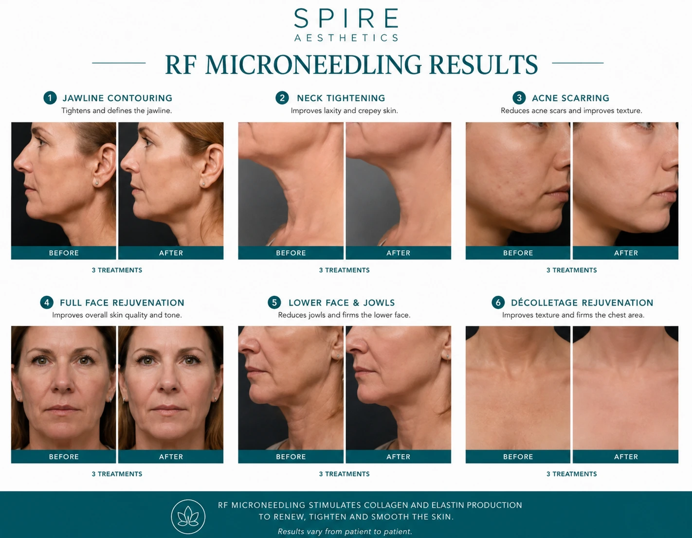RF Microneedling Skin tightening Halesowen results