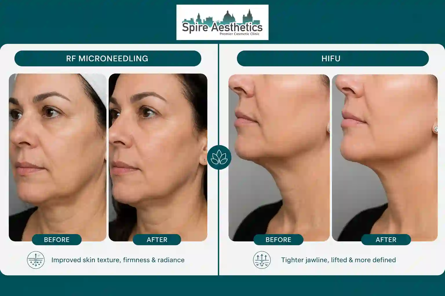 Can RF Microneedling and HIFU Be Combined Halesowen?