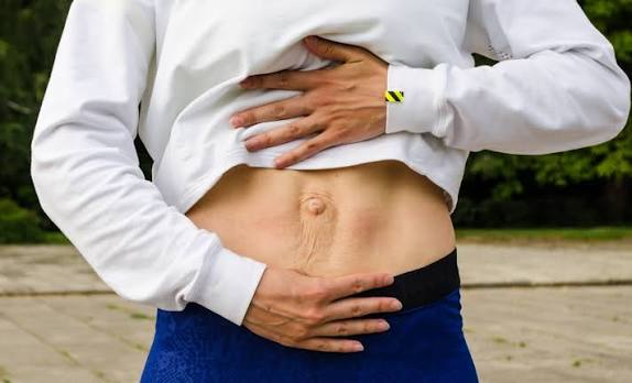 When Could Diastasis Recti Be the Missing Piece of the Puzzle Halesowen?