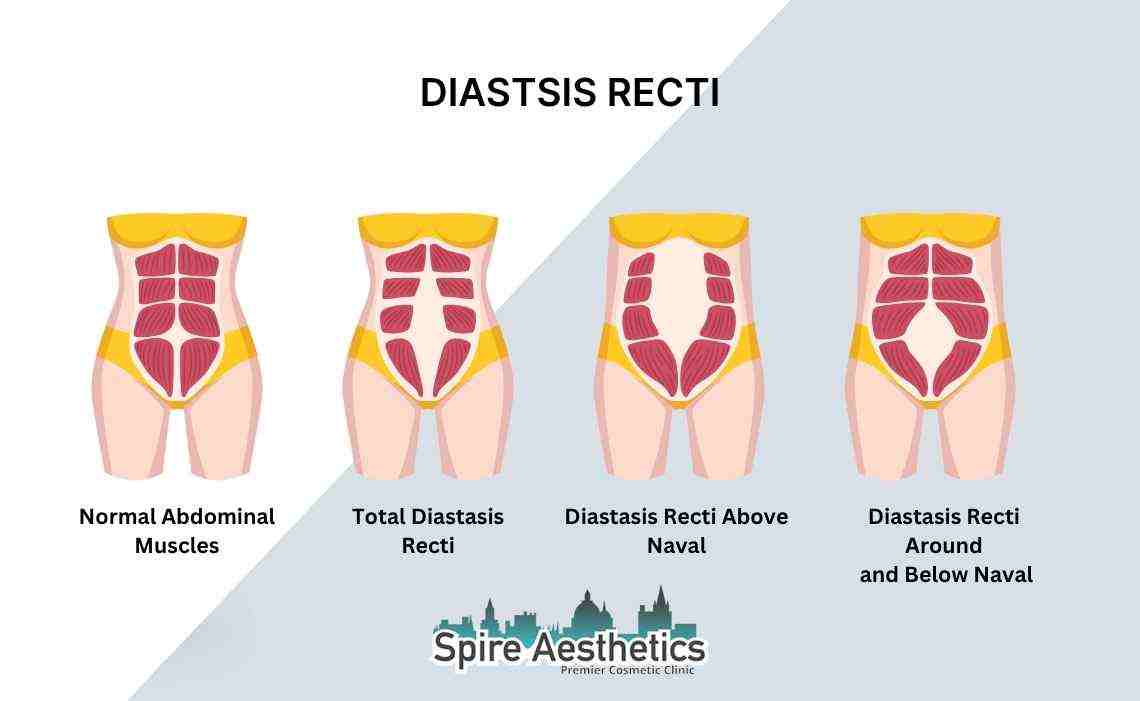 Is Non-Surgical Diastasis Recti Treatment Right for You? Common Concerns Answered Halesowen